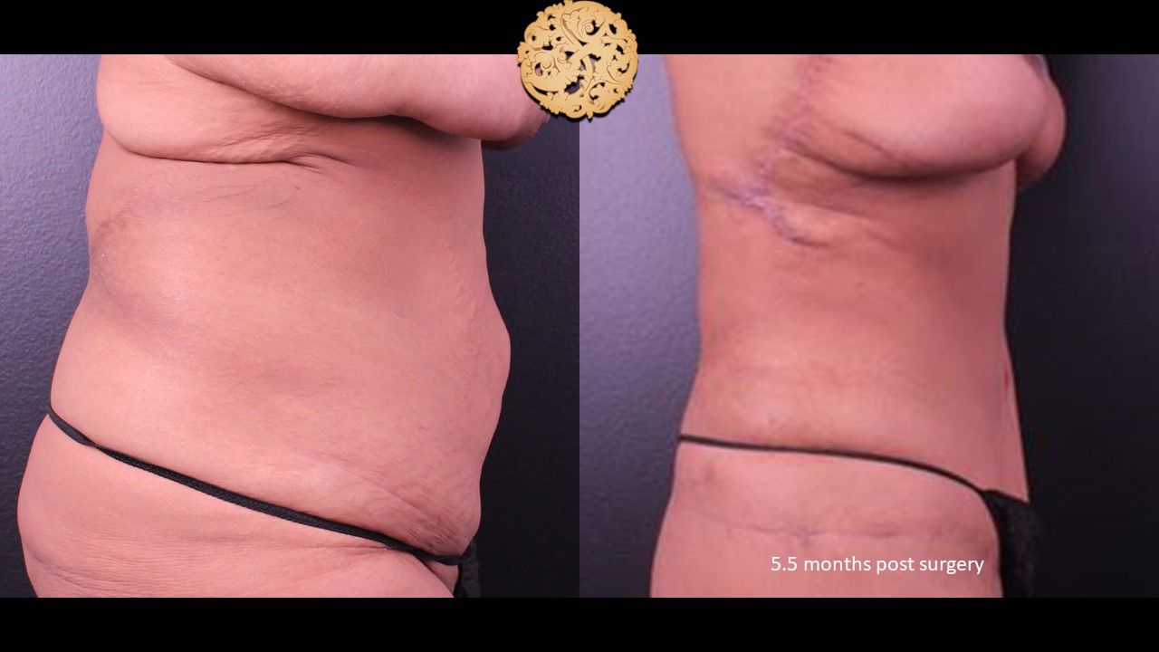 Liposuction Trunk Before & After