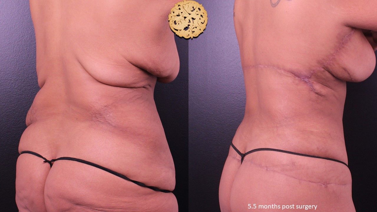 Liposuction Trunk Before & After