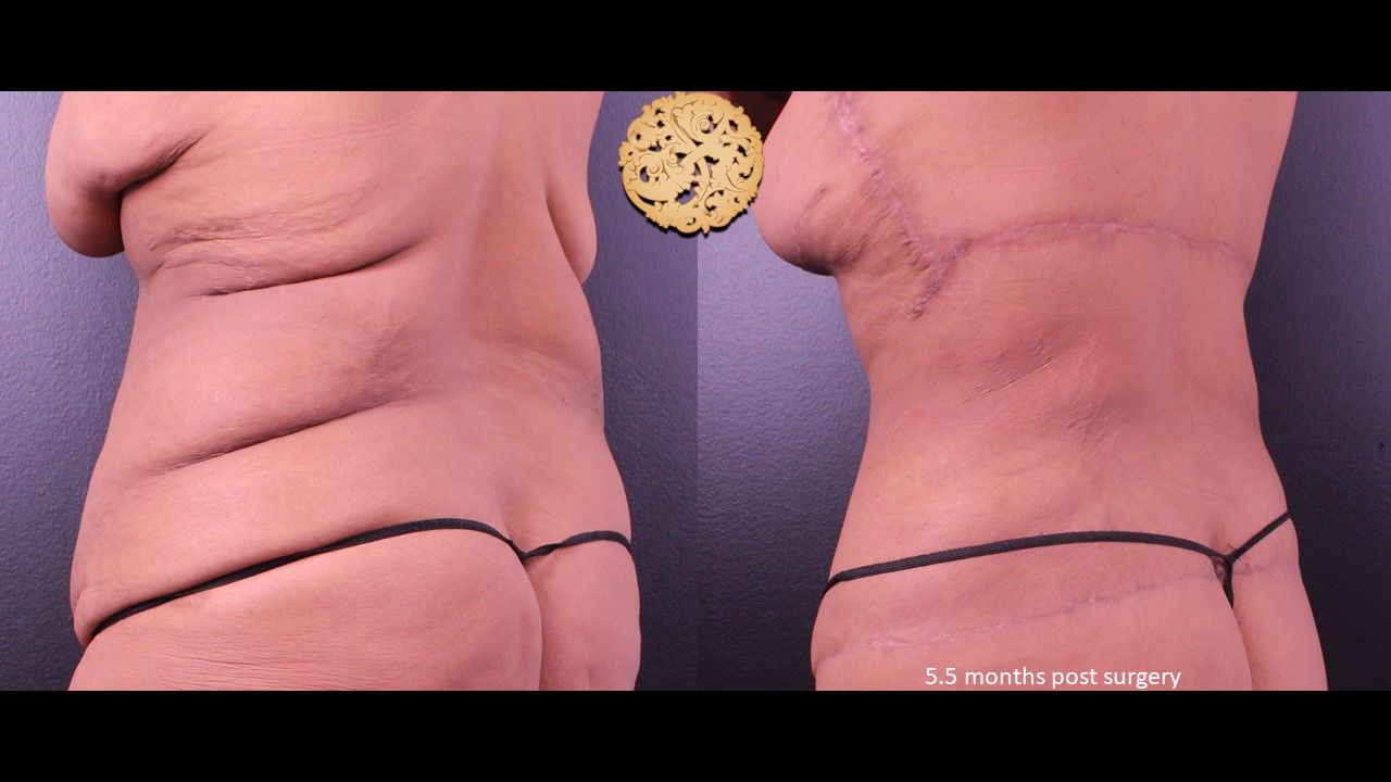 Liposuction Trunk Before & After