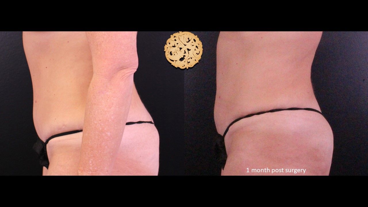 Liposuction Trunk Before & After