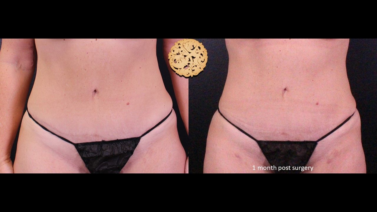 Liposuction Trunk Before & After