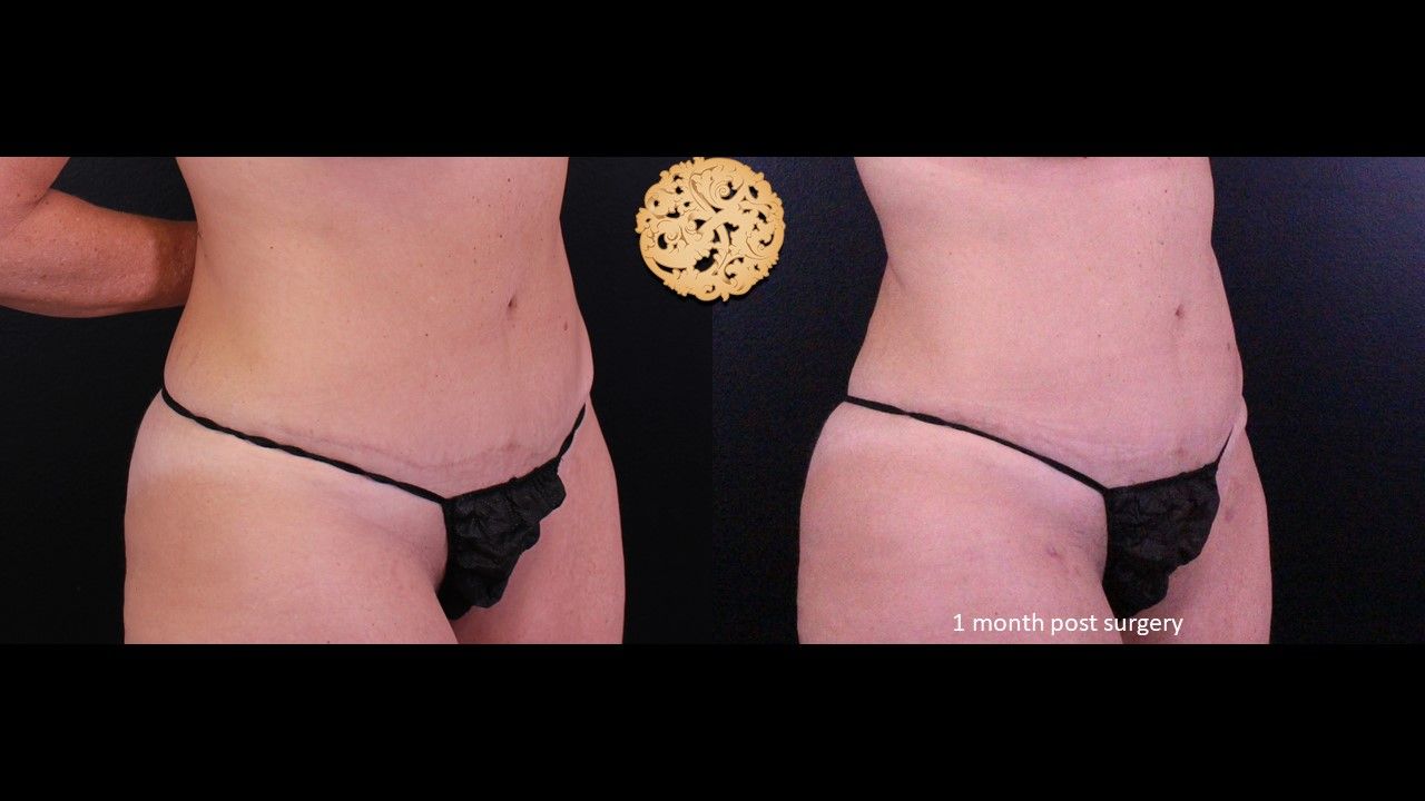 Liposuction Trunk Before & After