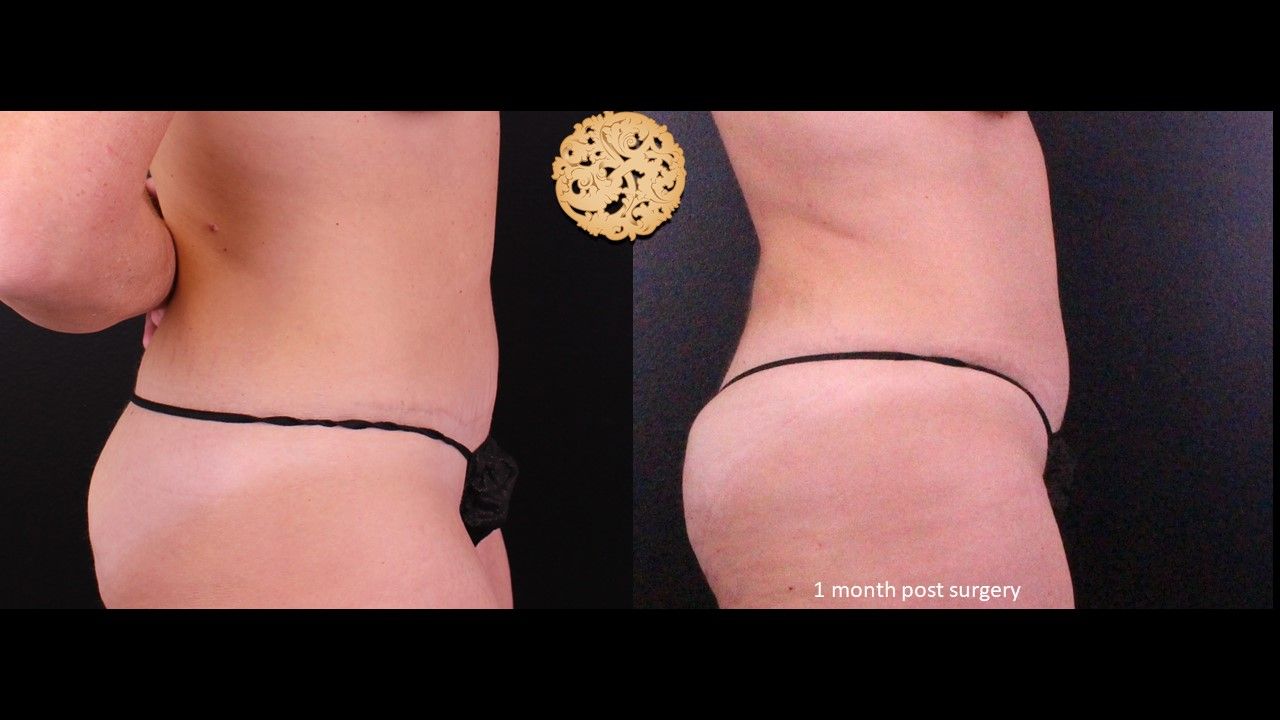 Liposuction Trunk Before & After