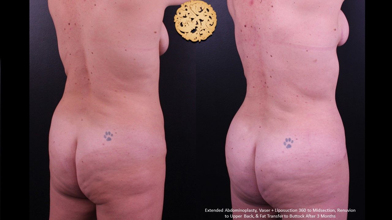Liposuction Trunk Before & After