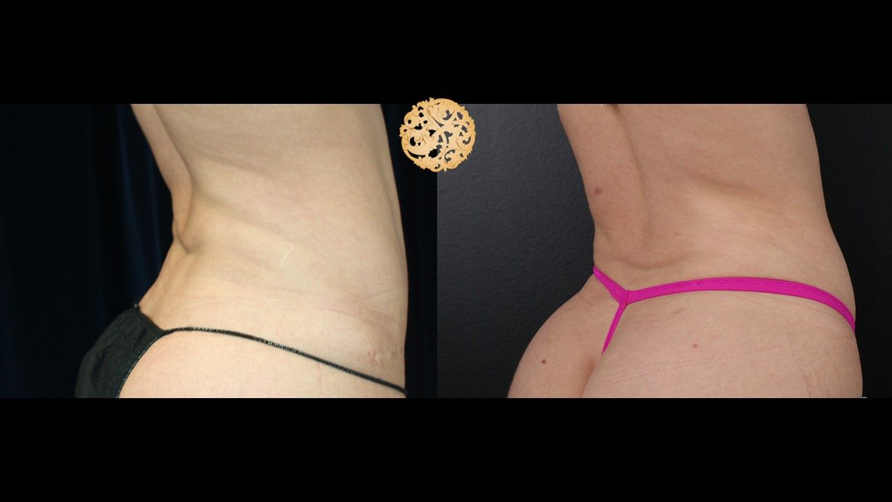 Liposuction Trunk Before & After