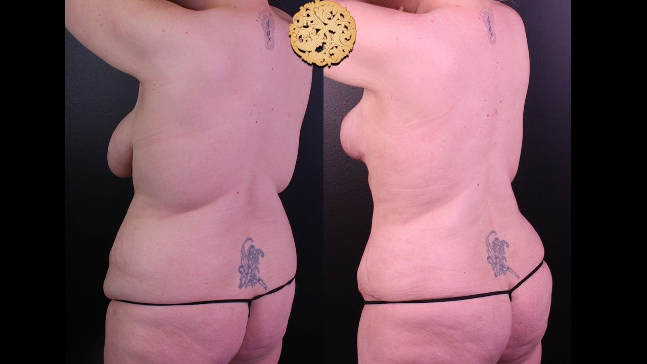 Liposuction Trunk Before & After