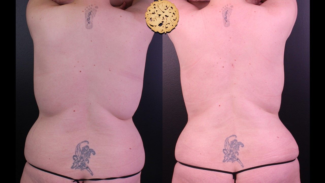 Liposuction Trunk Before & After
