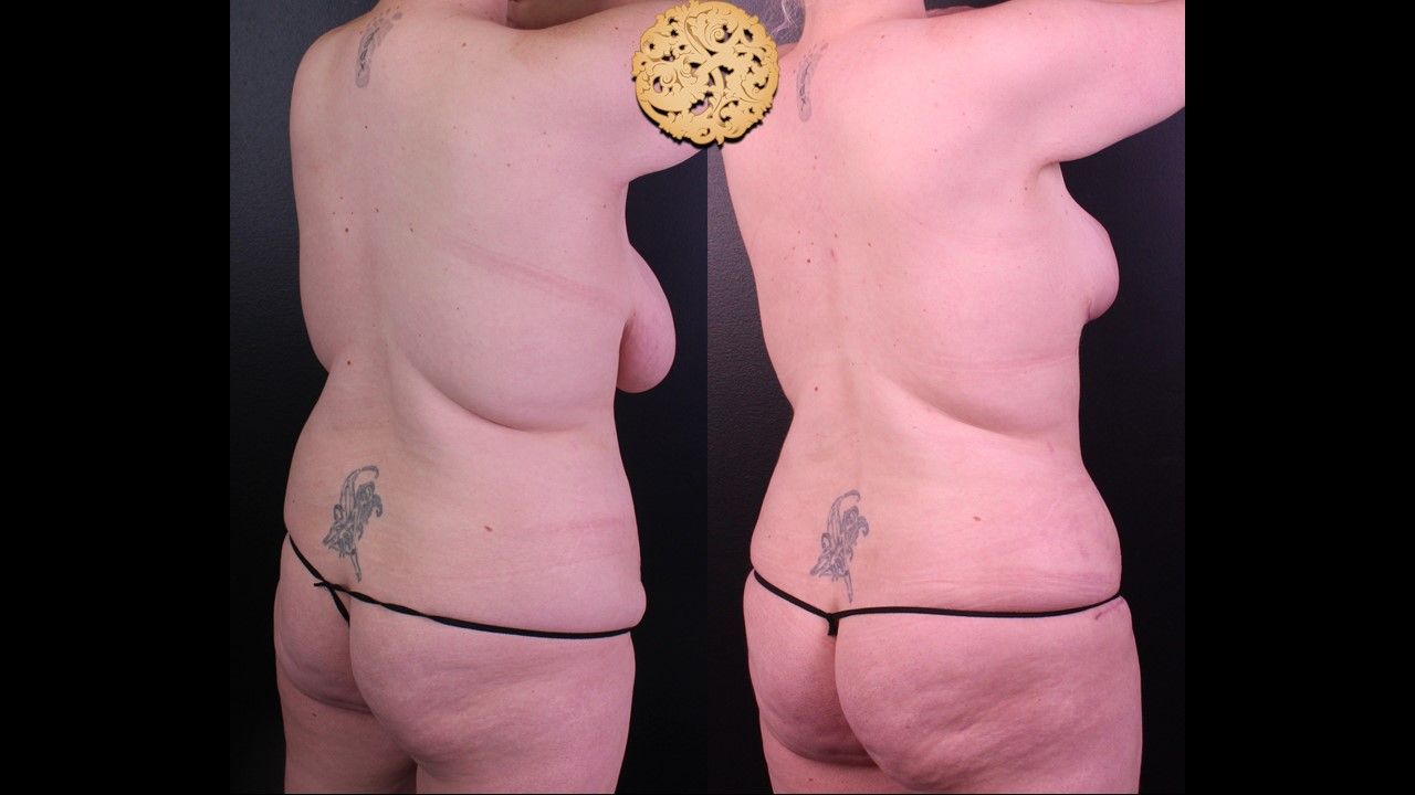 Liposuction Trunk Before & After