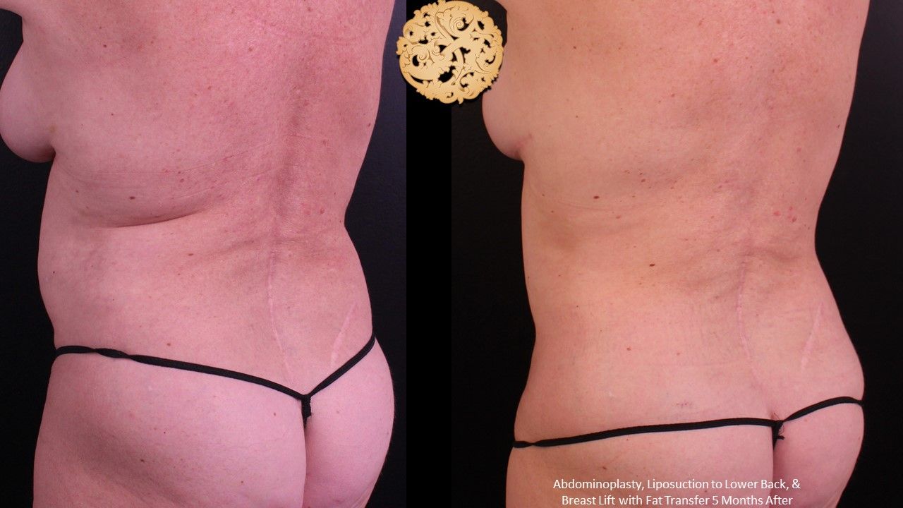 Liposuction Trunk Before & After