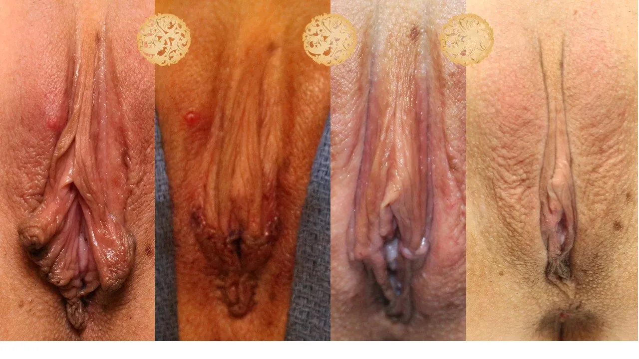 Vaginal Rejuvenation Before & After