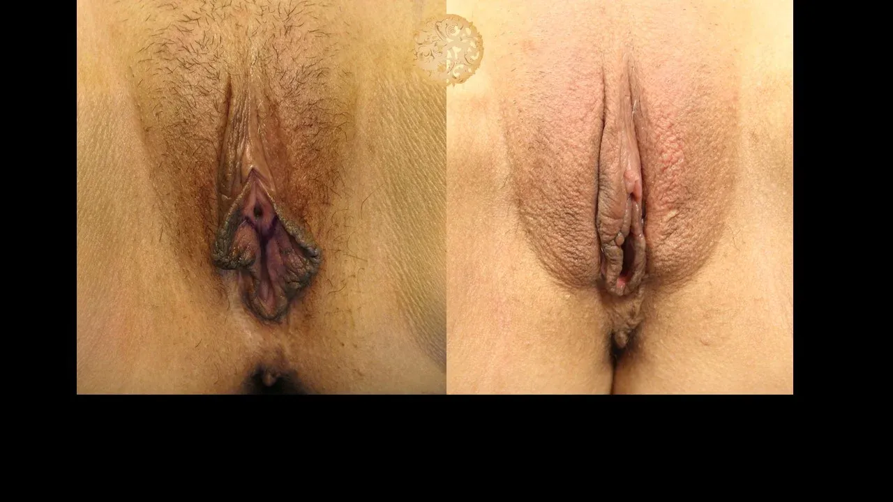 Vaginal Rejuvenation Before & After