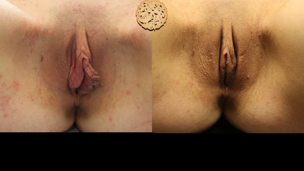 Vaginal Rejuvenation Before & After