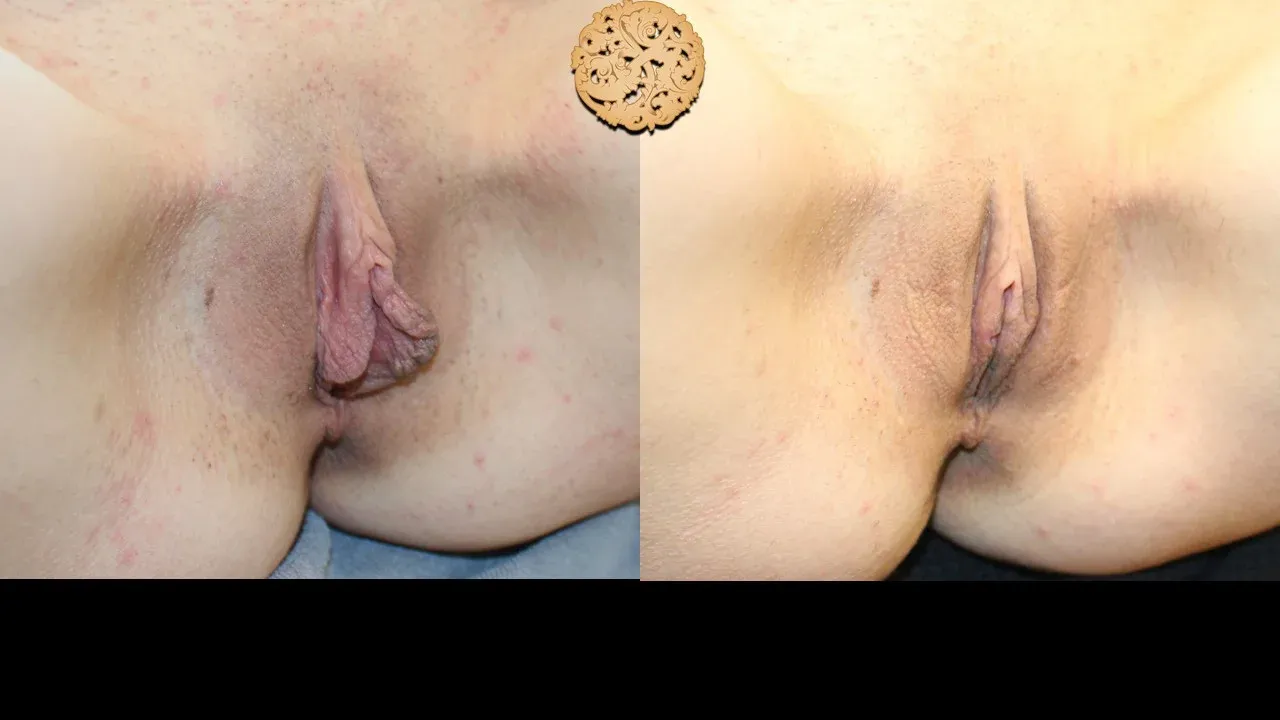 Vaginal Rejuvenation Before & After