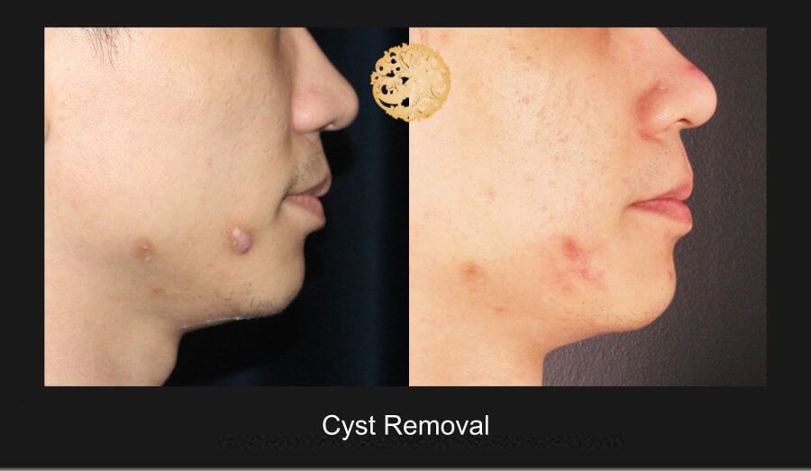 Cyst Removal Before & After