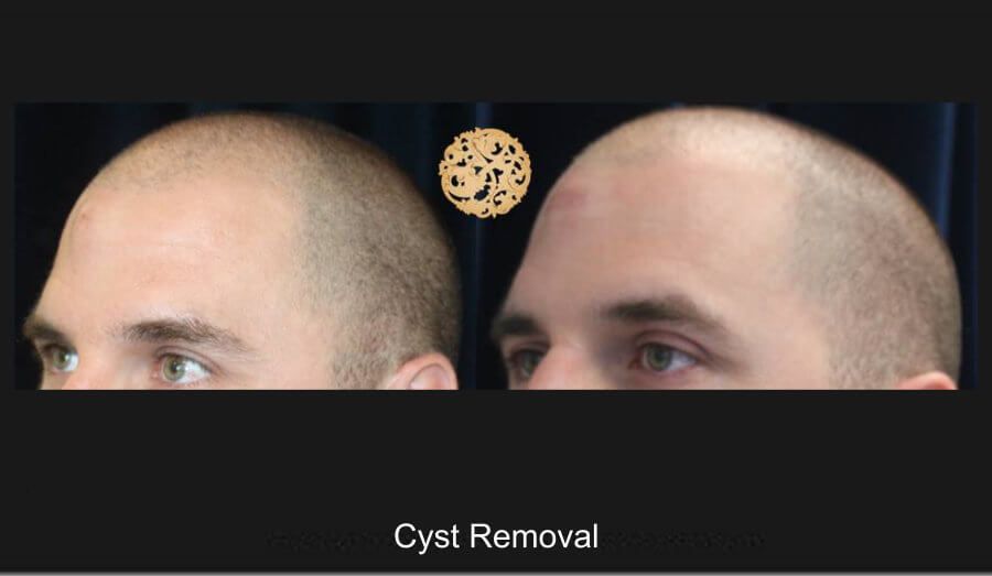 Cyst Removal Before & After