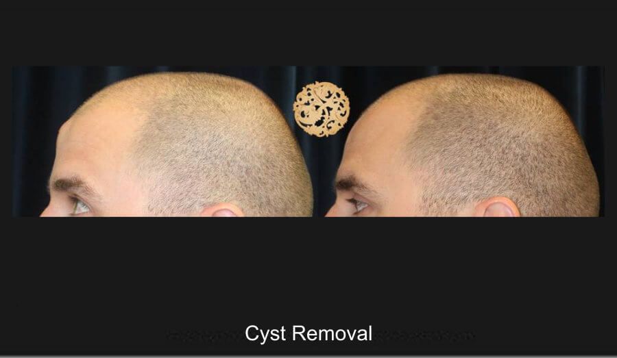 Cyst Removal Before & After