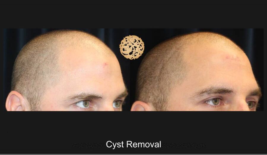 Cyst Removal Before & After