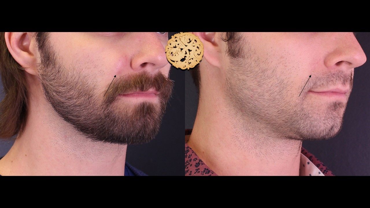 Cyst Removal Before & After