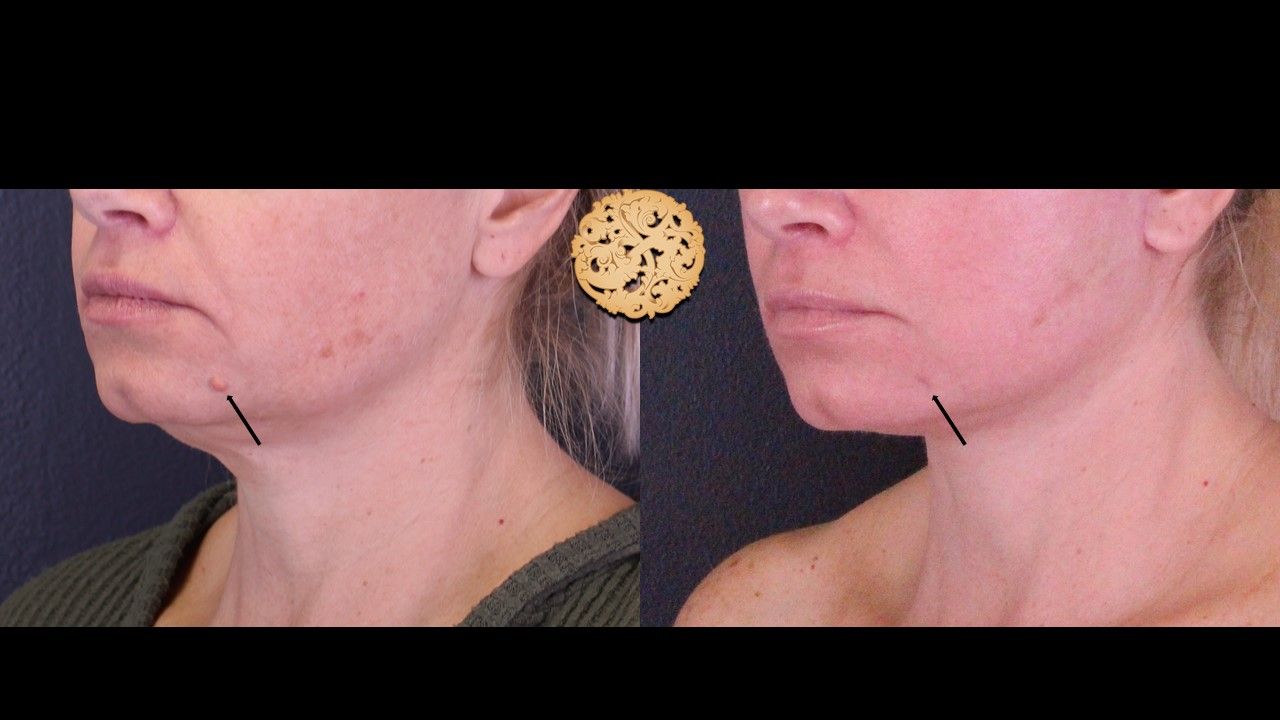 Cyst Removal Before & After