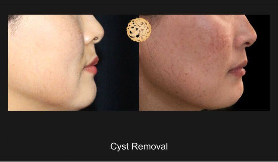 Cyst Removal Before & After