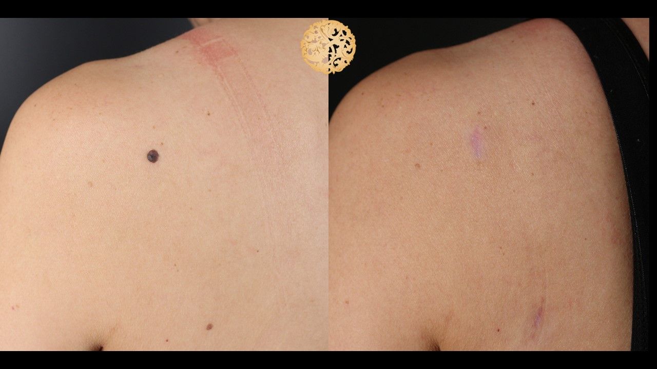 Cyst Removal Before & After
