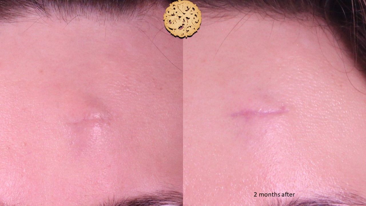 Scar Revision Before & After