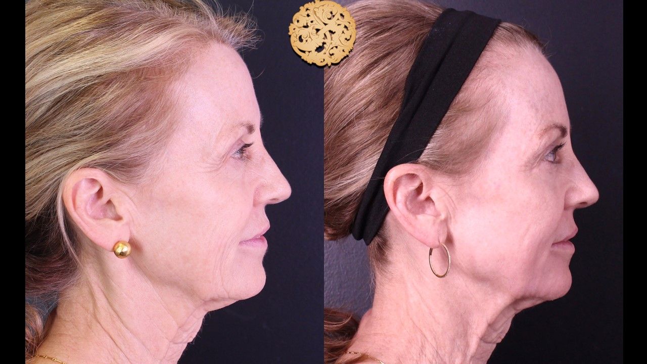 Profractional Before & After