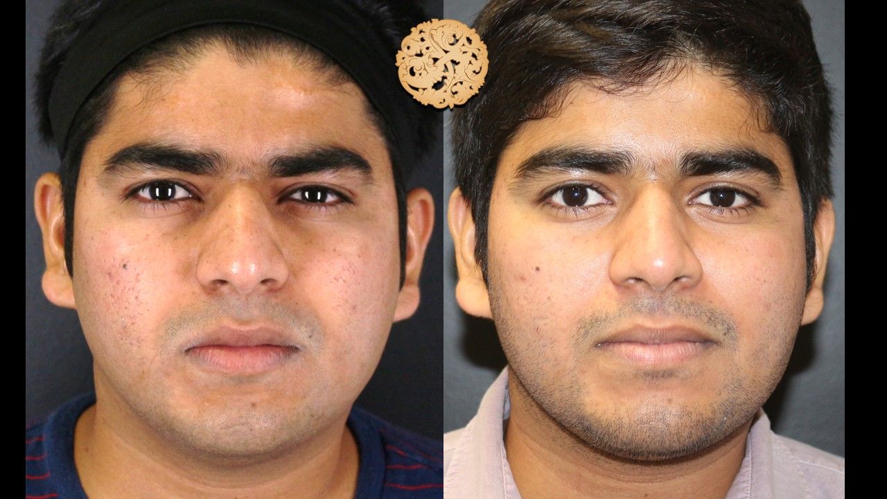 Profractional Before & After