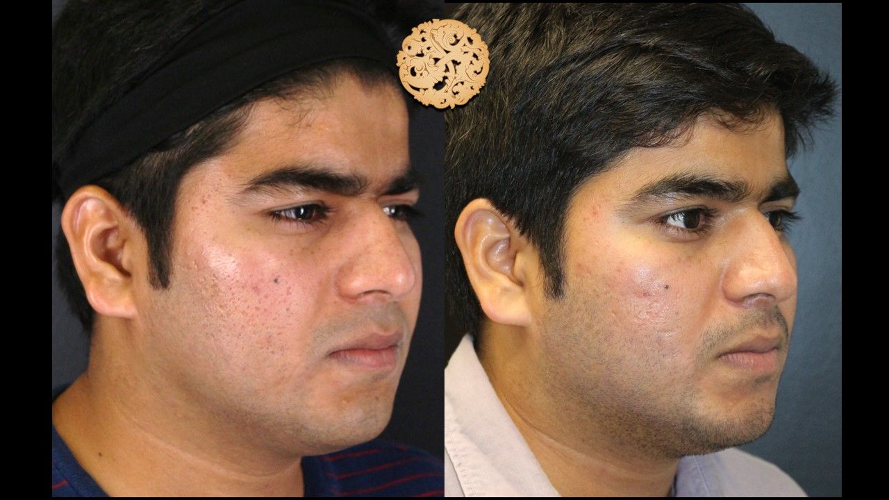 Profractional Before & After