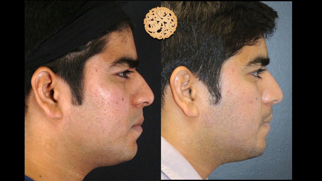 Profractional Before & After