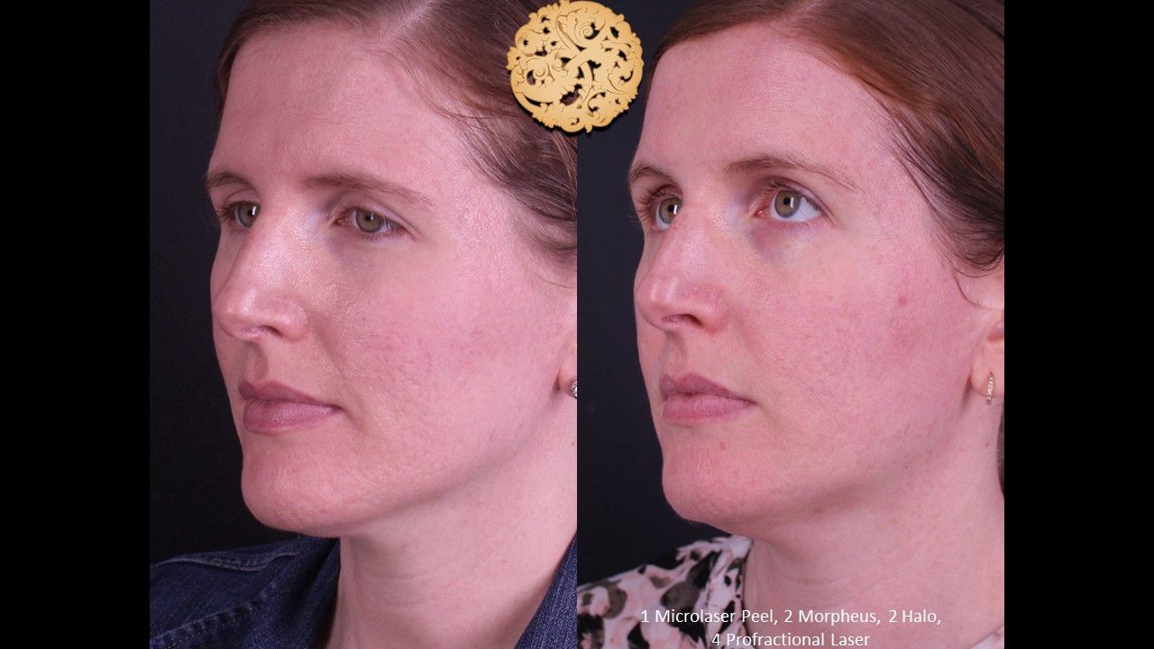 Profractional Before & After