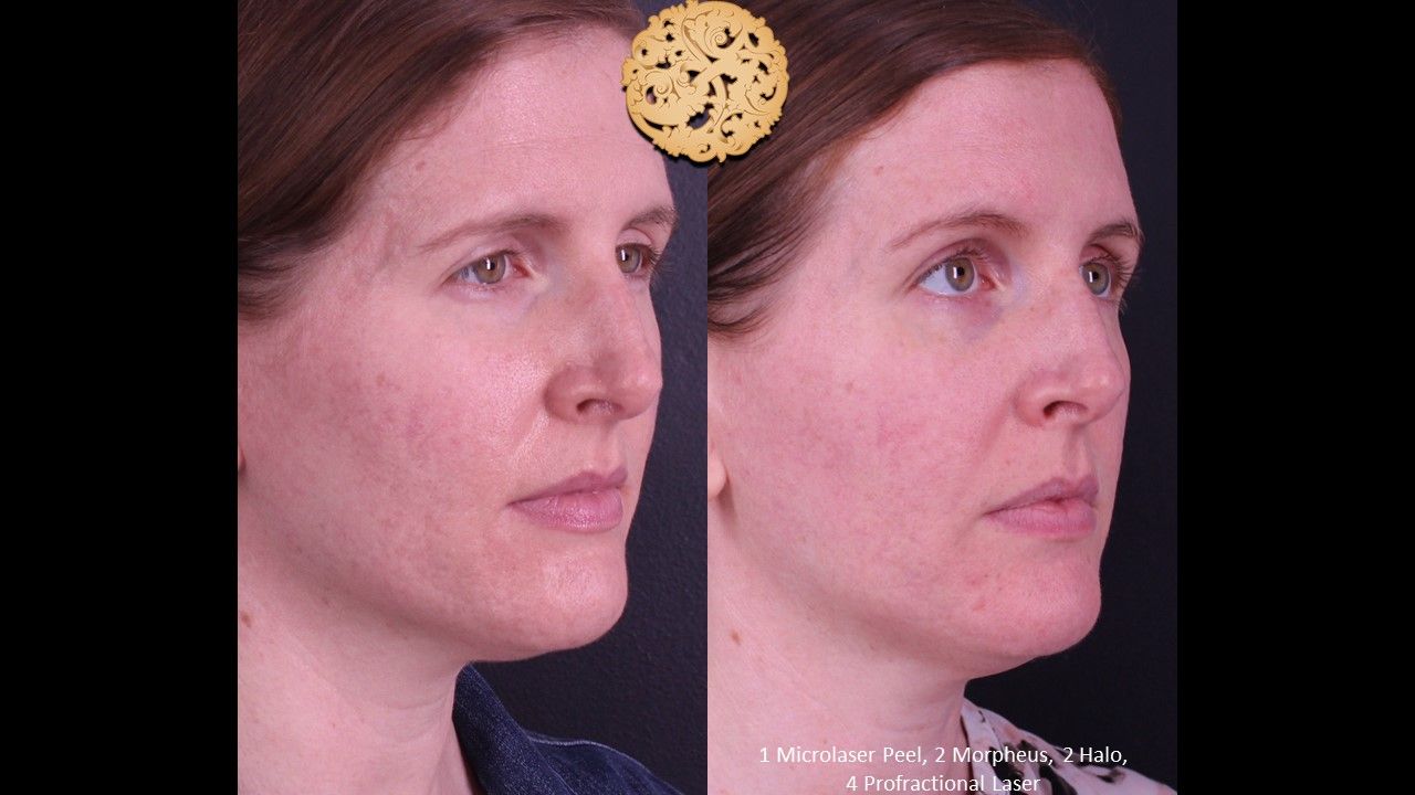 Profractional Before & After