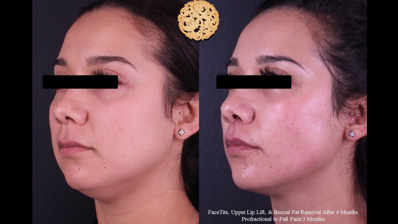 Profractional Before & After