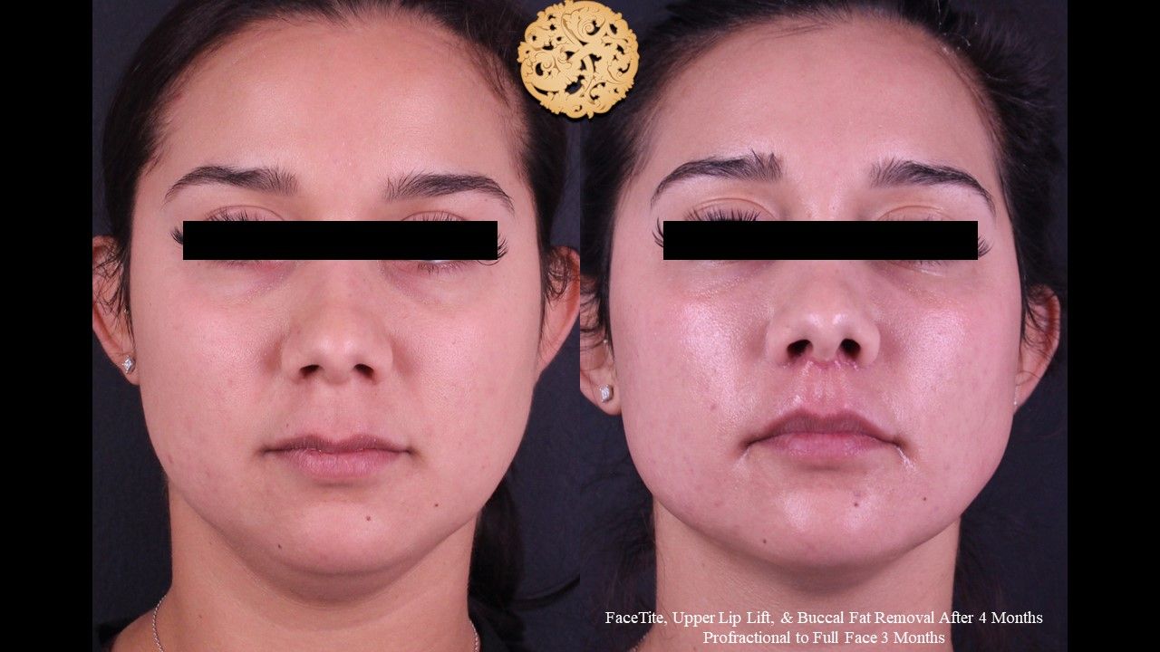 Profractional Before & After