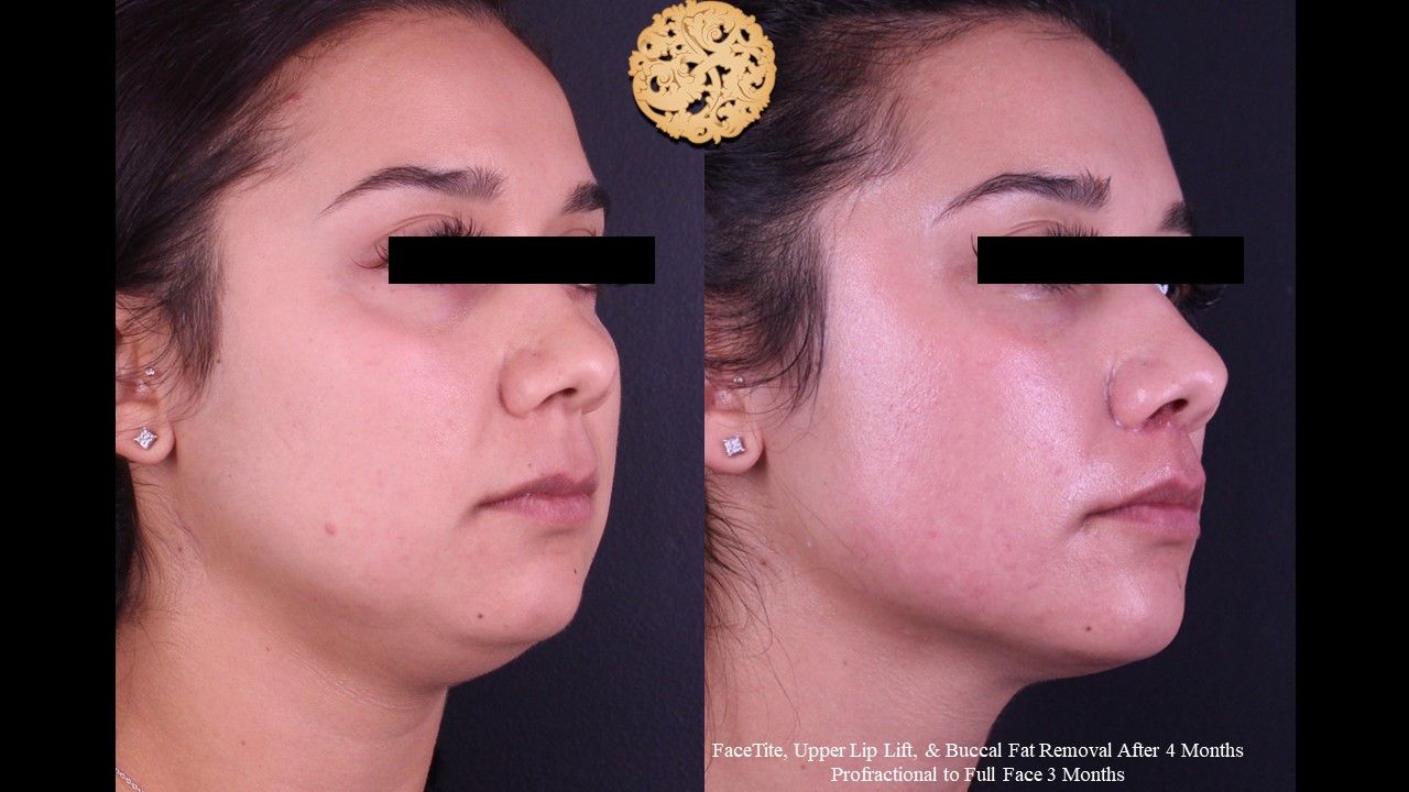 Profractional Before & After