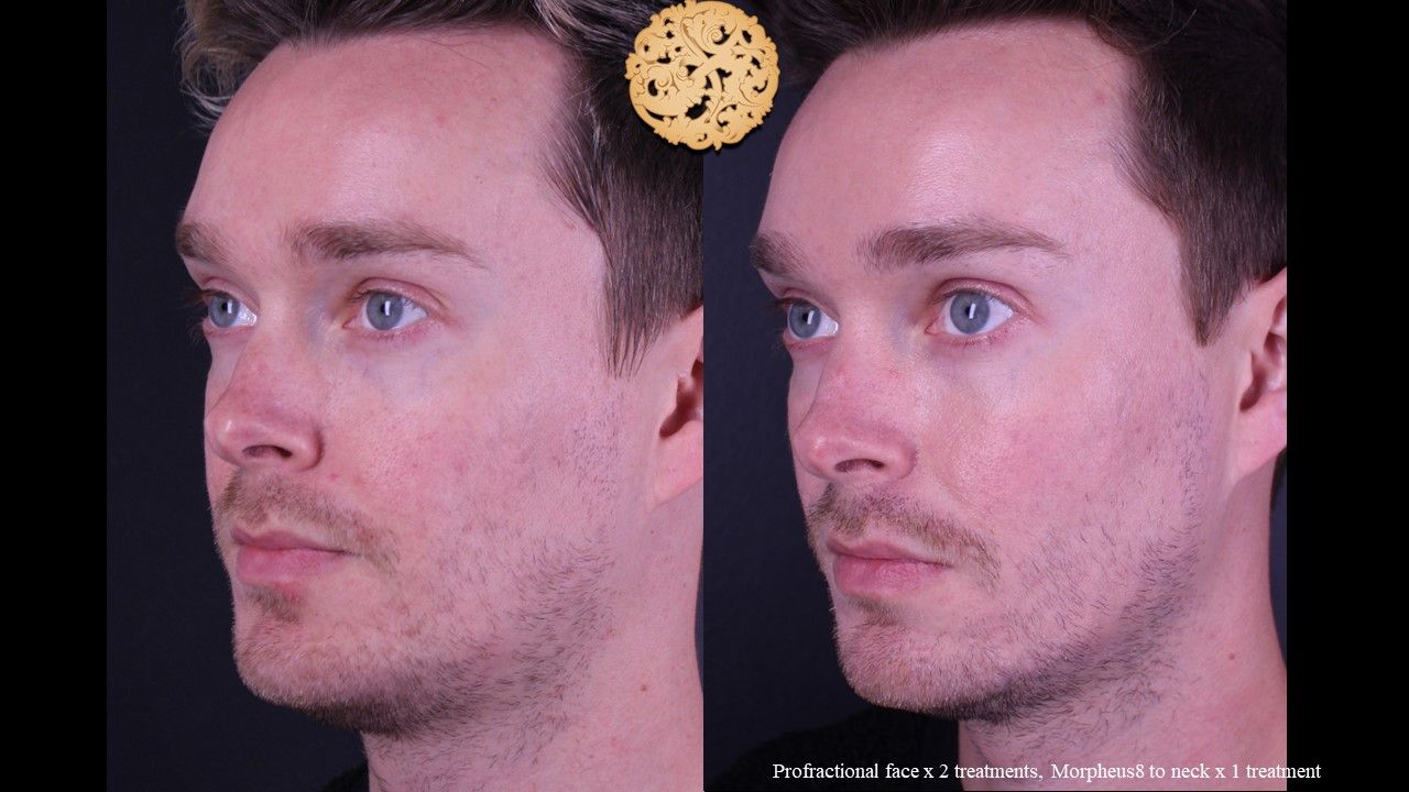 Profractional Before & After