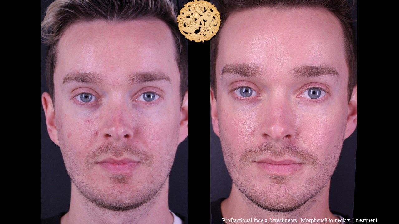 Profractional Before & After