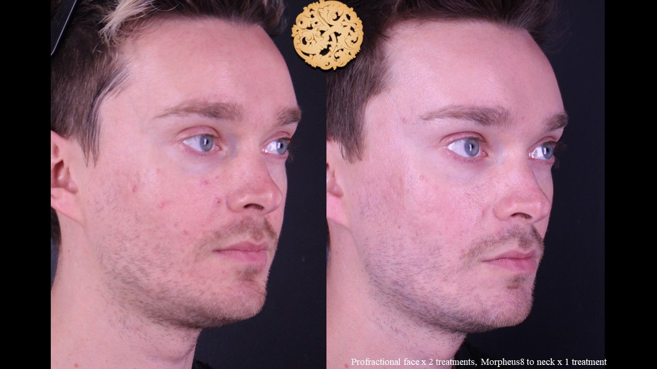 Profractional Before & After