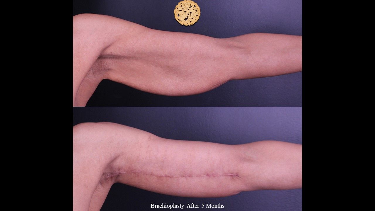 Brachioplasty Before & After