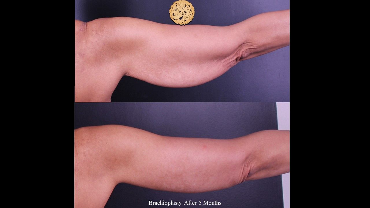 Brachioplasty Before & After