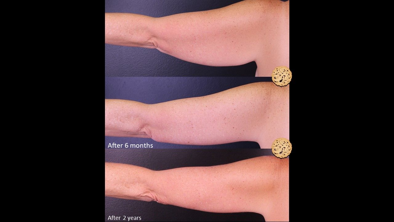 Brachioplasty Before & After