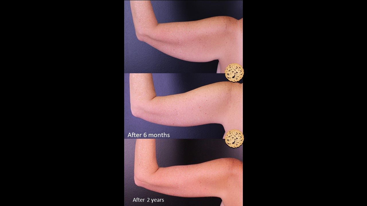 Brachioplasty Before & After