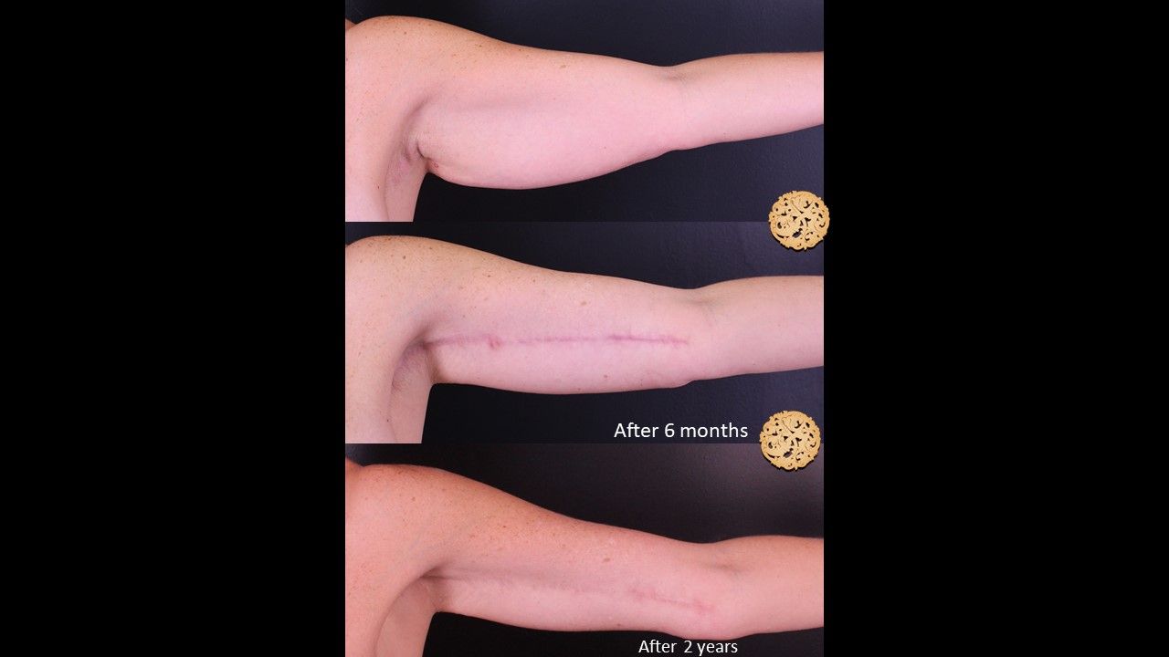 Brachioplasty Before & After