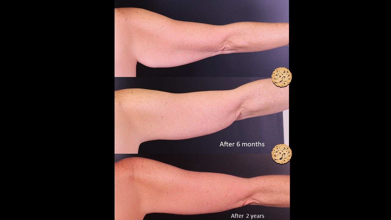 Brachioplasty Before & After