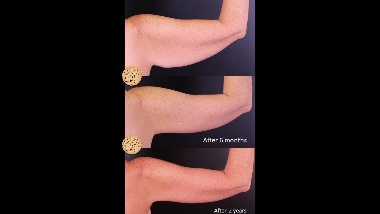 Brachioplasty Before & After