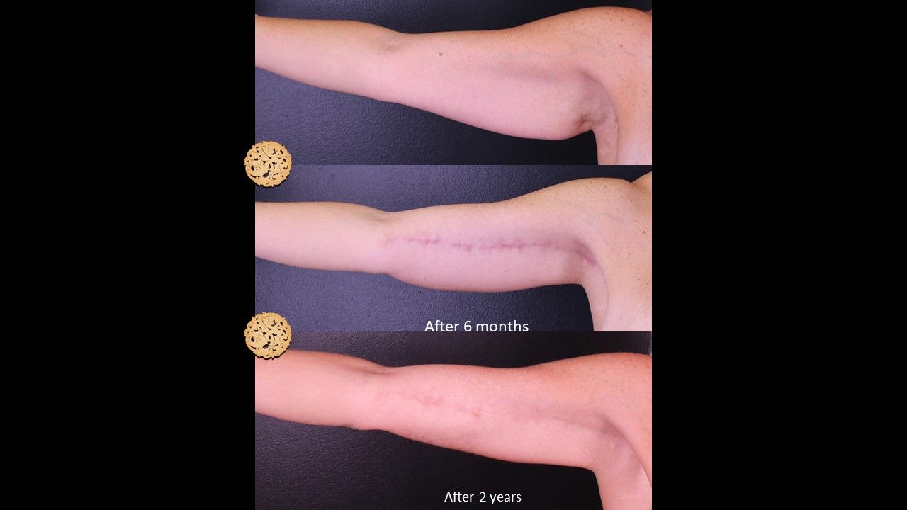 Brachioplasty Before & After
