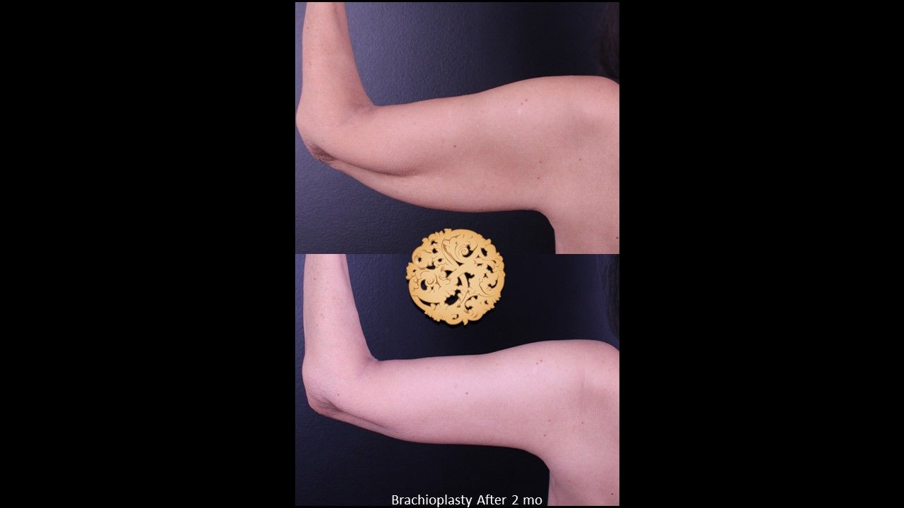 Brachioplasty Before & After