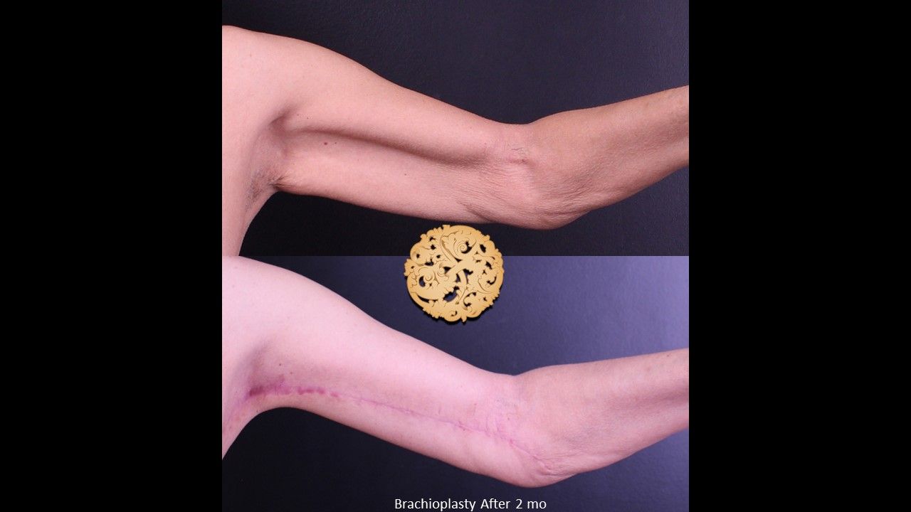 Brachioplasty Before & After