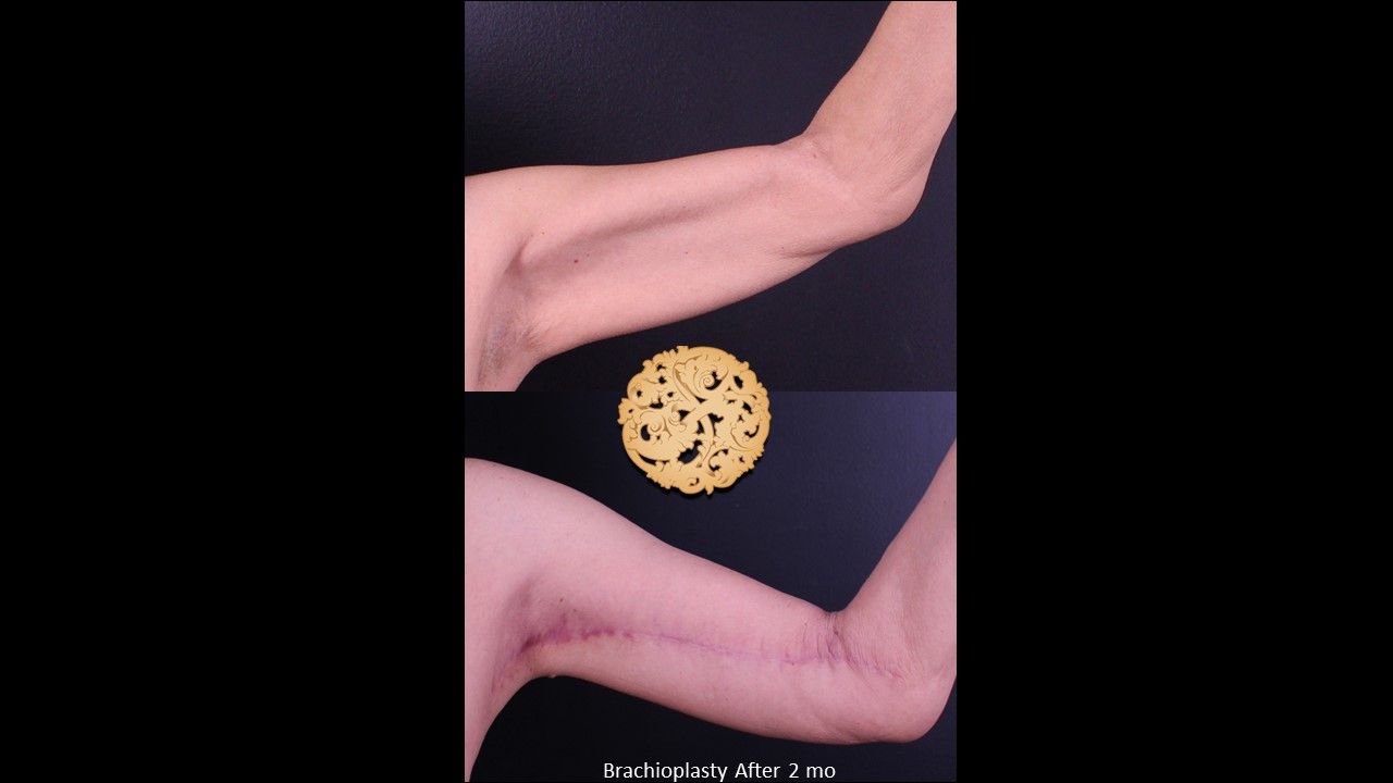 Brachioplasty Before & After