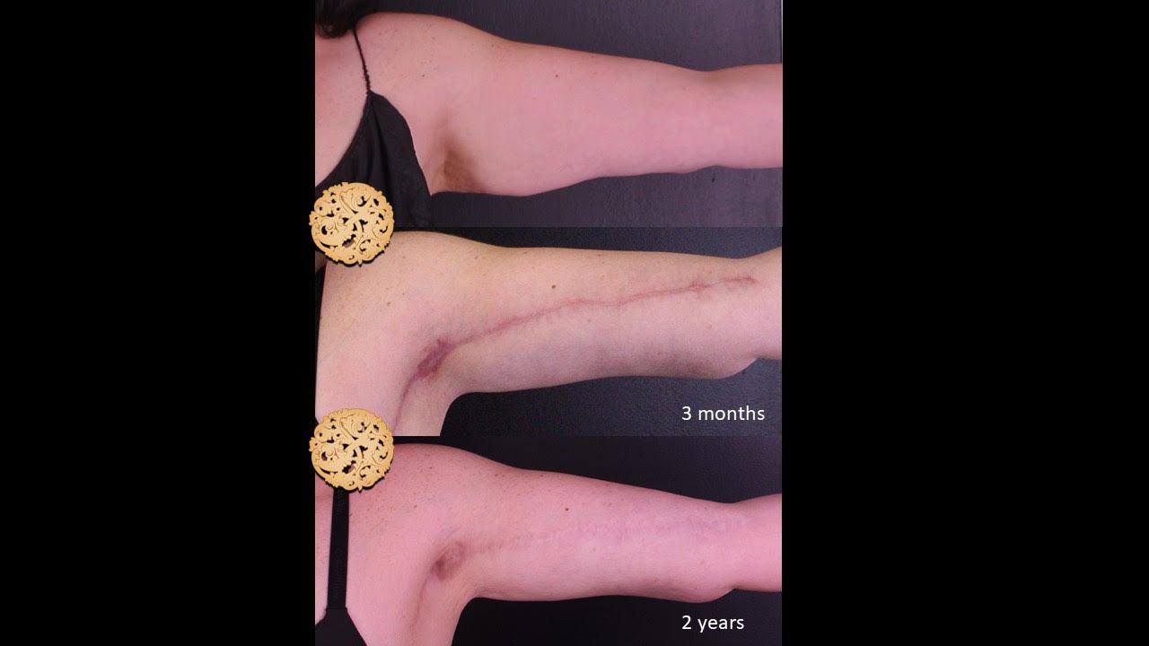 Brachioplasty Before & After